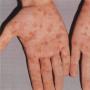 Symptomer på syfilis hos barn Barn kan bli smittet av syfilis fra voksne